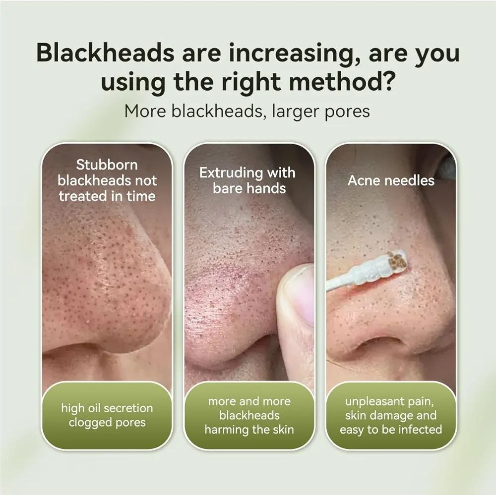 LAMBÉNA Crème + 60 Bandes - Masque pour éliminer les points noirs sur le visage et le nez